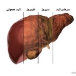 درمان چربی کبد