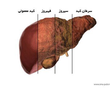 درمان چربی کبد