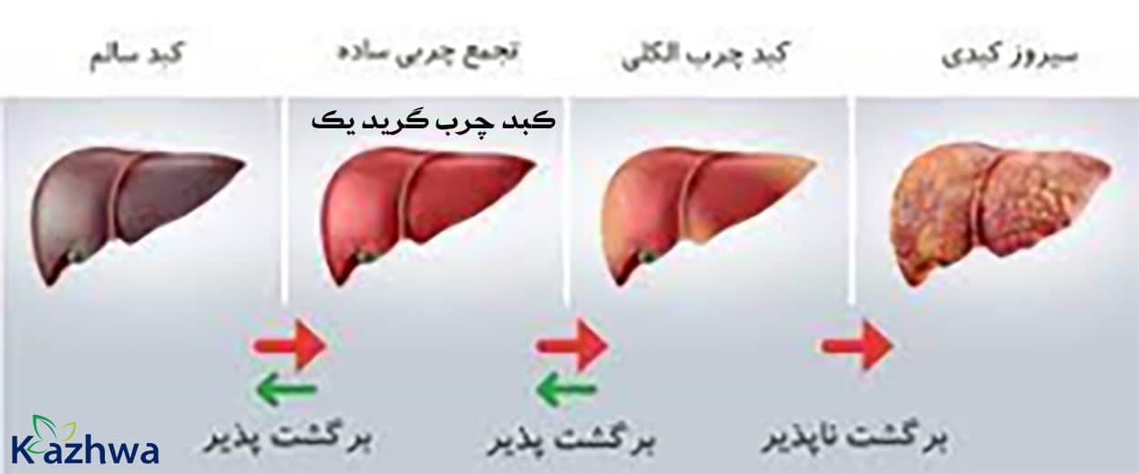 داروی گیاهی چربی کبد گرید یک