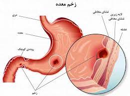 داروی گیاهی رفلاکس معده