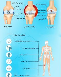 درمان خانگی آرتزوز و درد مفاصل