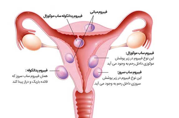 داروی درمان میوم و فیبروم کاژوا