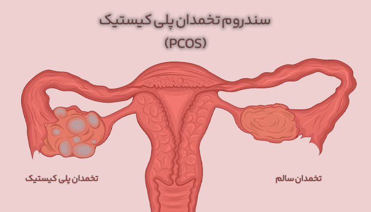 سندروم تخمدان پلی کیستیک